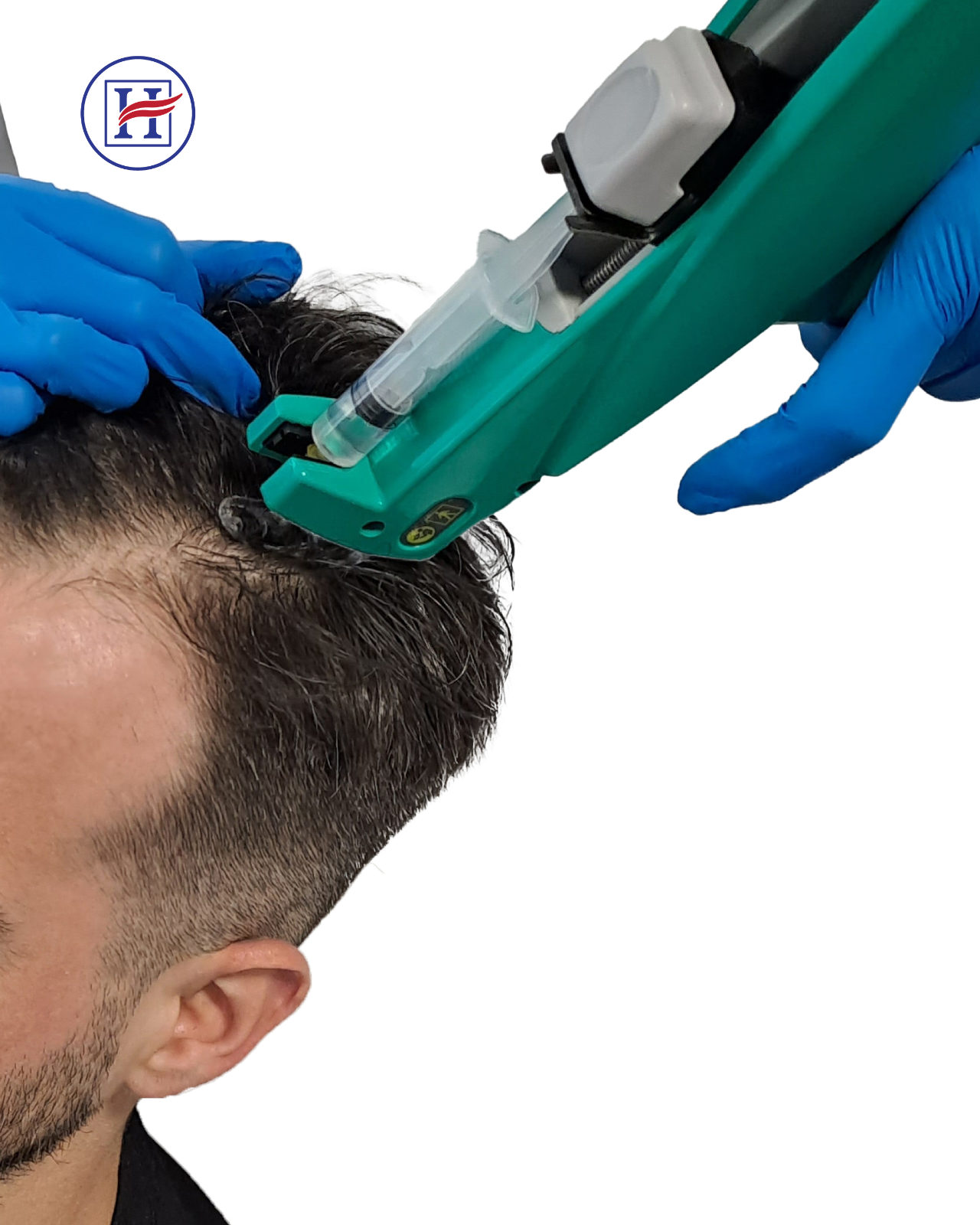 Tratamiento de mesoterapia capilar